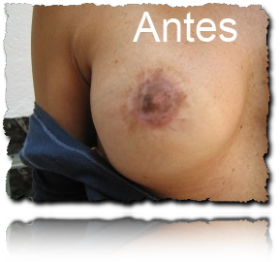 pez�n prostetico antes de ser aplicado 